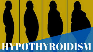 The thyroid gland plays an important role in tissue metabolism and development. Hypothyroidism Physiopedia