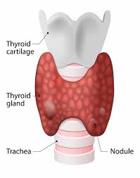 Thyroid nodule evaluation