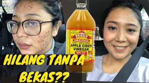 Check spelling or type a new query. Manfaat Cuka Apel Untuk Wajah Berjerawat Youtube