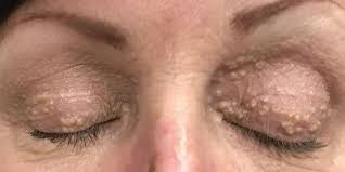 Ever wonder why you have tiny white bumps that won't pop? Watch Dr Pimple Popper Remove So Many Milia From This Patient S Eyelids Dr Pimple Popper