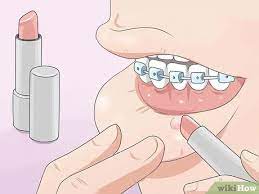 How to stop braces pain wikihow. How To Make Your Braces Hurt Less With Pictures Wikihow
