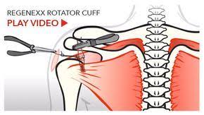 Can A Torn Rotator Cuff Heal On Its Own Without Surgery Rotator Cuff Rotator Cuff Tear Shoulder Surgery