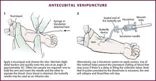 Image result for Venous Blood Sampling