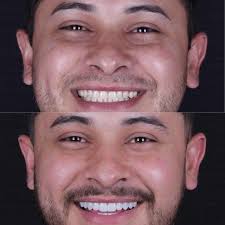 Bora iniciar a semana com o resultado dessa transformação do sorriso by Dr. Felipe  Valverde. Aumentamos um pouquinho os dentes, fechando os espacinhos entre  eles e dando aquele toque de sutileza +