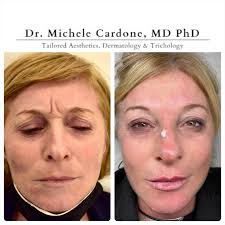 Questa è una mia paziente. Uno di quegli esempi di quella che chiamo  medicina estetica migliorativa, non-trasformativa. È senza trucco, senza  filtri, ha i segni del trattamento che ha appena fatto,