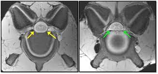 Wobbler Syndrome What We Know And Where We Re Headed The Horse