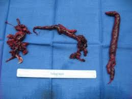 The presence of a blood clot in the lung may identify with the condition known as pulmonary embolism, which is described as arterial blockage in the lungs that leads to inhibition of the normal functioning of the lungs. Pulmonary Embolism The Killer Clot In The Lungs Myheart