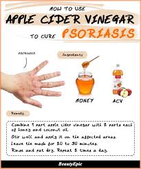 Apple cider vinegar (acv) is a trending home remedy that's being used to treat a variety of conditions, including infections, obesity, and diabetes. How To Use Apple Cider Vinegar For Psoriasis Psoriasis Cure Psoriasis Diet Home Remedies For Eczema