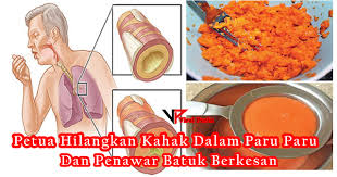 Adakah asthma saya terkawal ? Inilah Petua Berkesan Menghilangkan Kahak Dari Dalam Paru Paru Dan Penawar Batuk Berkesan Kartel Dakwah