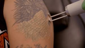 Most common way to remove a tattoo. Laser Tattoo Removal In Malaysia Price Side Effects Aftercare And More