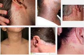 We did not find results for: Cara Atasi Kulit Leher Gatal Kering Dan Mengelupas