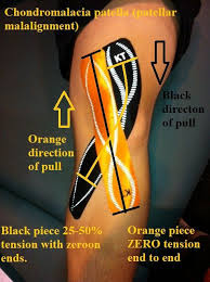 Pin By Shonna Giraudo On Training Every Day Chondromalacia Kinesiology Taping Kt Tape