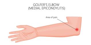 Tennis elbow management a multimodal management. Golfer S Elbow What Are The Causes Ultrasound Guided Injections