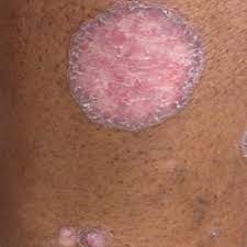 The lesions are arranged in a circular fashion, or they become so by peripheral extension with central clearing. Annular Atrophic Lichen Planus Responds To Hydroxychloroquine And Acitretin Mdedge Dermatology