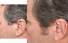 Biotin is not only great for your hair, it's also extremely beneficial in other areas of health and in fact crucial for some key biological processes in the human body. Does Help Hair Shake Reverse Gray Hair Results From Dr Cooleys Office In Charlotte North Carolina Help Hair