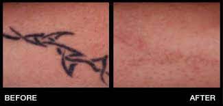 We do not treat clients like a walking wallet like most tattoo. Laser Tattoo Removal Miami Tattoo Removal Hollywood Pembroke Pines