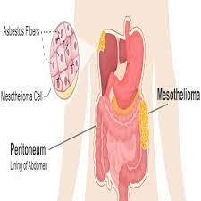 Mesothelioma symptoms depend on the type and the stage. Intraperitoneal Mesothelioma Discussion Symptoms