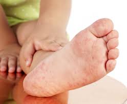 Researchers say many babies may be getting too many baths, and two to three a week is enough. What To Do If Your Child Has Eczema Health Essentials From Cleveland Clinic