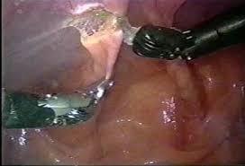 Image result for Radical Prostatectomy