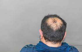 Check spelling or type a new query. Alopecia Areata Gejala Penyebab Dan Mengobati Alodokter