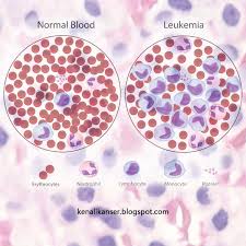 Lymphoma ( limfoma ) adalah sejenis kanser yang berkaitan dengan pembelahan secara tidak normal sel2 pada lymphatic system.dinamakan walaupun punca2 terjadinya lymphoma tidak disahkan secara terperinci namun pakar perubatan mengariskan perkara2 berikut yang memberi. Apa Itu Kanser Lymphoma Maklumat Ini Saya Ambil Dari Wikipedia