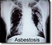 Asbestos Homeowner Information Health Effects Eh Minnesota Department Of Health