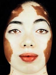 Entdecke rezepte, einrichtungsideen, stilinterpretationen und andere ideen zum ausprobieren. This Photographer Is Shooting Almost 100 People With Vitiligo I D