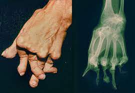 Causes of deformity in the rheumatoid thumb. Rheumatoid Arthritis Symptoms Johns Hopkins Arthritis Center
