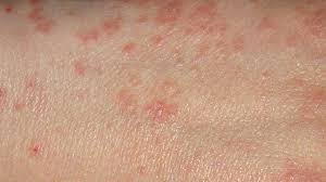 Image result for scabies in the groin area