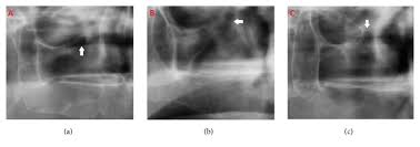 Haller cells are anterior ethmoid air cells extending into the maxillary sinus (figure 17). The Appearance Of The Infraorbital Canal And Infraorbital Ethmoid Haller S Cells On Panoramic Radiography Of Edentulous Patients Abstract Europe Pmc