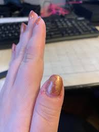 Consequences and effects of biting nails. Stopped Biting My Nails After 30 Years But Can T Stop Biting Picking The Skin Help Calmhands