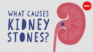 what causes kidney stones arash shadman