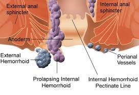 There are things you can do to treat and prevent treatment without surgery. How To Get Rid Of Hemorrhoids Types Causes And Treatments
