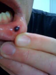 Explore pictures, causes, symptoms, treatments & home remedies. Gross Blood Blister Josh Rotenberg Flickr