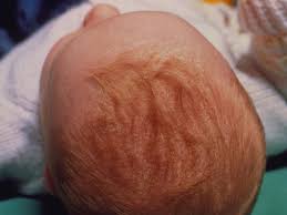 Image result for white scabs on the head in children