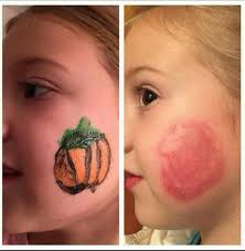 Chemical Burn From Craft Paint On The Face Painting Crafts Body Art Face Painting