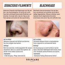Mitesser Oder Sebaceous Filaments Was Ist Der Unterschied Selfcare Society