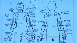 Slain Palmdale Boy Had Bb Lodged In His Groin Area Nurse Testifies