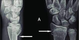 Check spelling or type a new query. Buckle Fracture