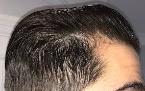 This stimulates collagen and elastin production, resulting. Dermarolling Success 2 Months In Pictures Attached Hairlosstalk Forums