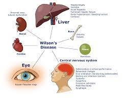 Wilson S Disease Is Characterized By A Disproportionate Amount Of Copper In The Body The Disease Is Genetic And It I Wilson S Disease Disease Kawasaki Disease