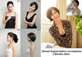 Every plastic surgeon has their own protocol for choosing implants and i hope to further. Breast Augmentation In Korea Seoul Guide Medical