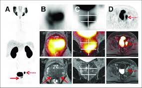 Being armed with information is vital to begin the fight. Primary Staging Using 68 Ga Psma11 Pet High Resolution T2 Weighted Mri Download Scientific Diagram