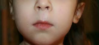 It has been 7 days since the txt. New York Lip Hemangioma Treatment Before And After Photos
