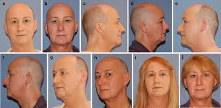 For more information or to schedule a consultation with dr. Figure 5 Frontal Bone Remodeling For Gender Reassignment Of The Male Forehead A Gender Reassignment Surgery Springerlink