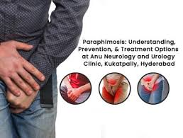 Image result for paraphimosis