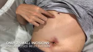 Gallbladder removal surgery is called cholecystectomy, which is performed either invasively or noninvasively. 18 Hours After Keyhole Surgery For Gallbladder Removal 3 Incisions Tummy View Youtube