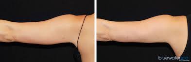 Coolsculpting arms before and after photos at nazarian plastic surgery in beverly hills. Coolsculpting Upper Arms Photo Gallery
