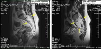 The overall survival rates are 68% at 5 years and 40% at 10 years. Chordoma Wikiwand