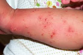 Image result for scabies human bites